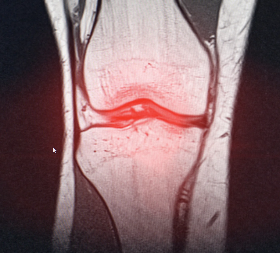 Osteoarthritis