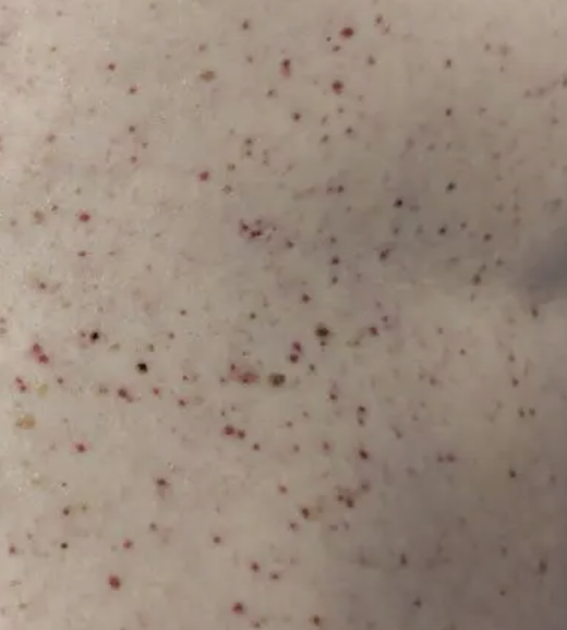 Urticaria pigmentosa