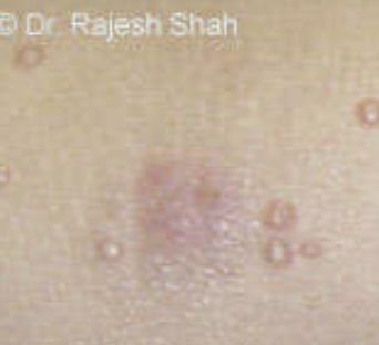 Molluscum Contagiosum