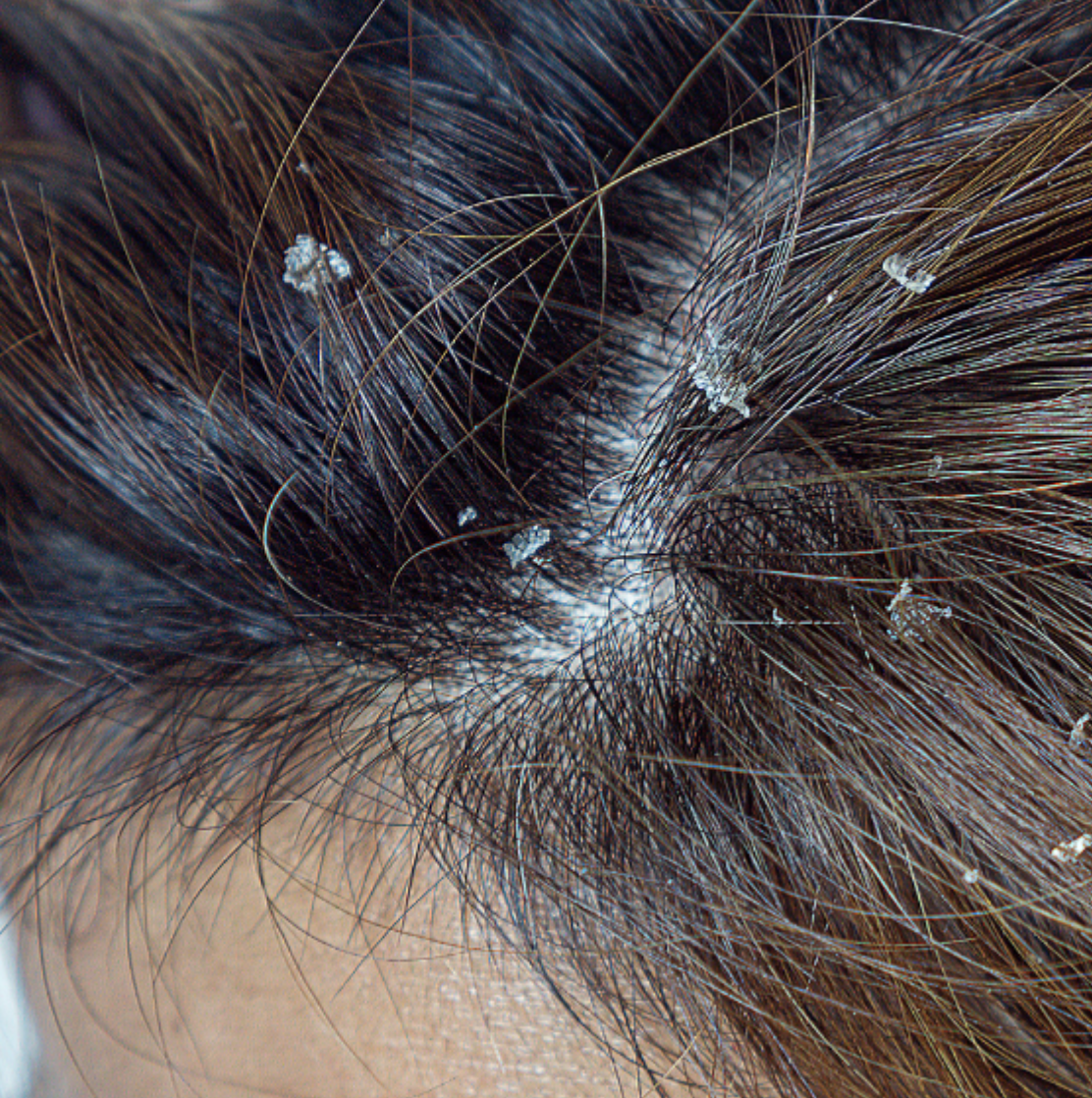 Seborrheic dermatitis