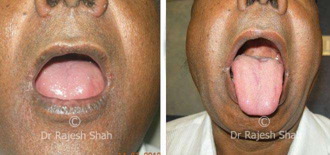 Psoriasis Before and After Case Photo