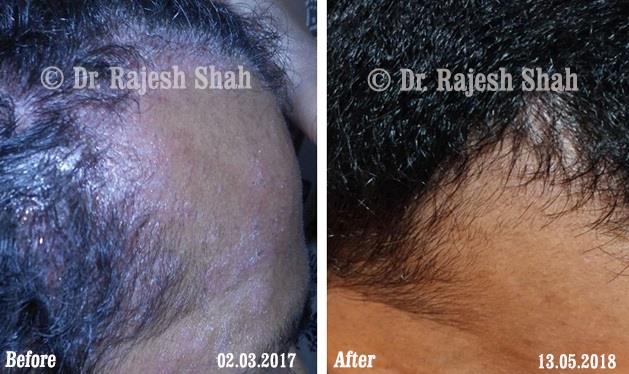Seborrhoeic Dermatitis Before and After Case Photo