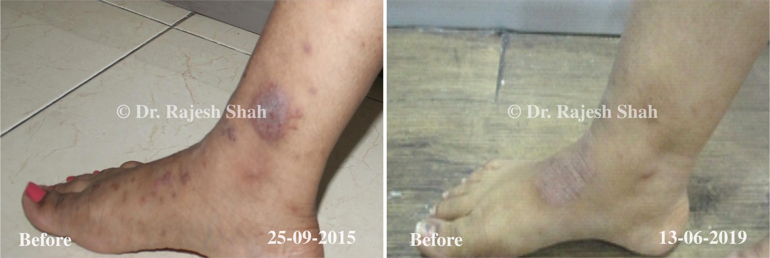 Psoriasis Before and After Case Photo