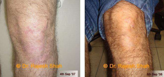 Psoriasis Before and After Case Photo