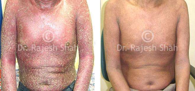 Psoriasis Before and After Case Photo