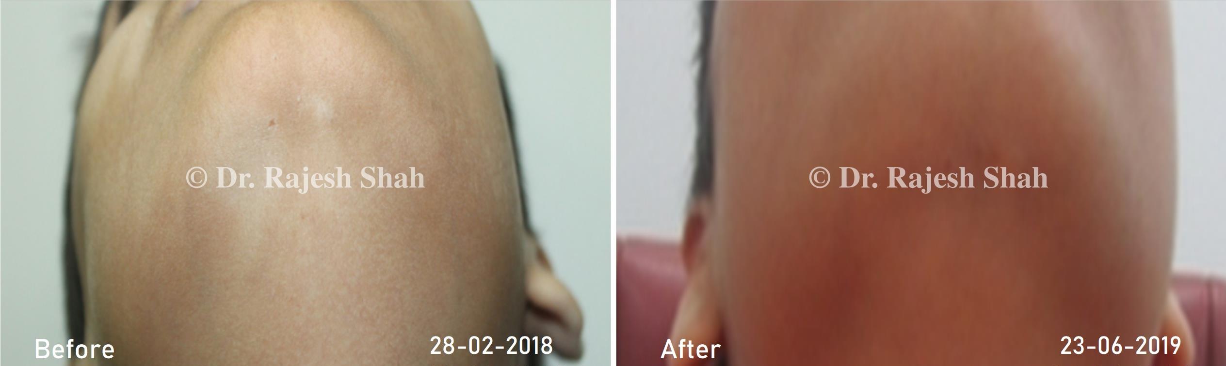 Pityriasis Alba Before and After Case Photo