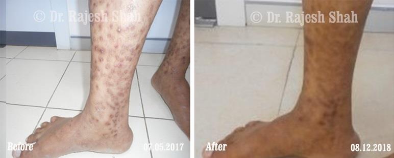 Lichen Planus Before and After Case Photo