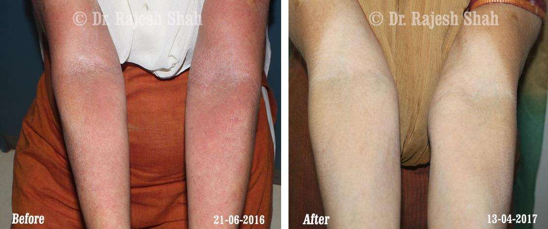 Psoriasis Before and After Case Photo