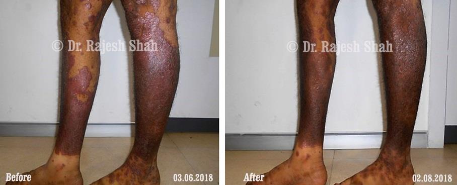Psoriasis Before and After Case Photo