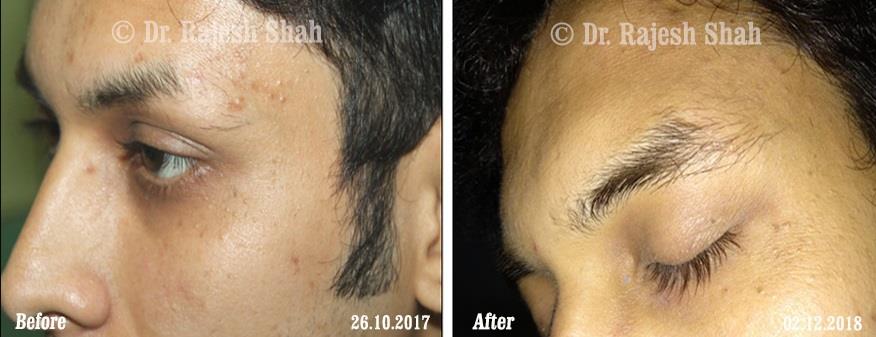 Alopecia Areata Before and After Case Photo
