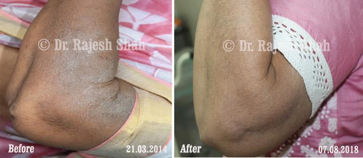 Eczema Before and After Case Photo