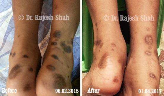 Lichen Planus Before and After Case Photo