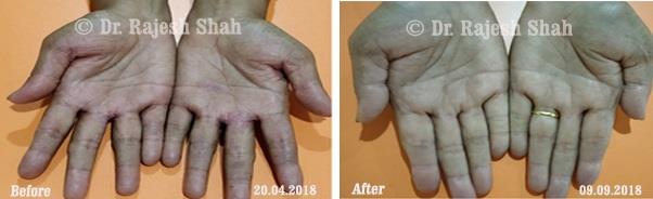 Psoriasis Before and After Case Photo
