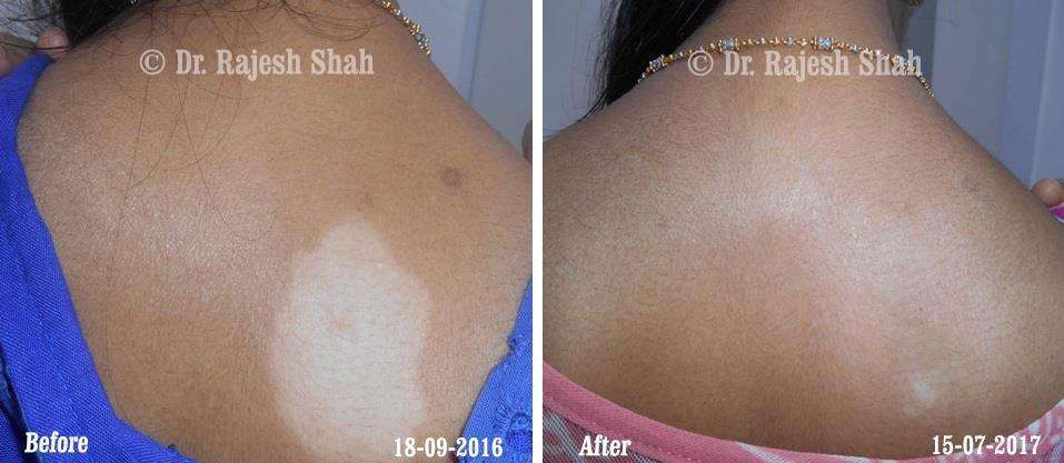 Vitiligo Before and After Case Photo
