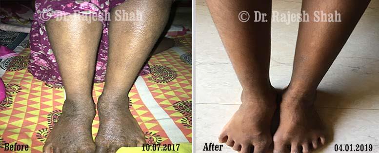 Atopic Dermatitis Before and After Case Photo