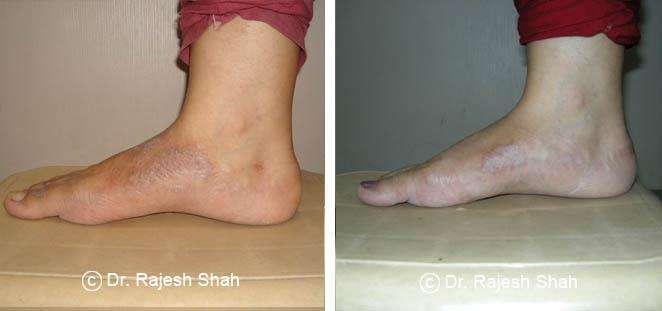 Psoriasis Before and After Case Photo