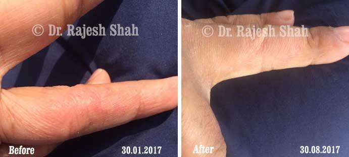 Atopic Dermatitis Before and After Case Photo