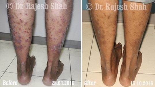 Psoriasis Before and After Case Photo