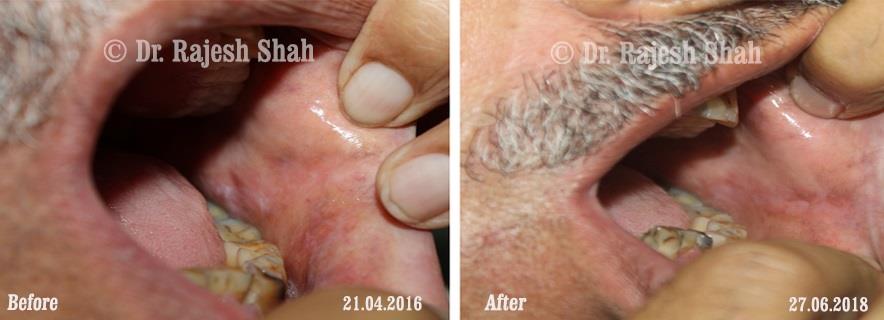 Lichen Planus Before and After Case Photo