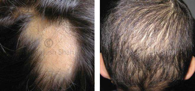 Alopecia Areata