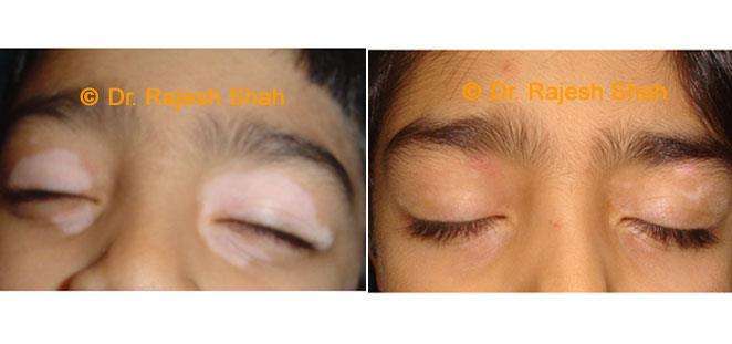 Vitiligo Before and After Case Photo