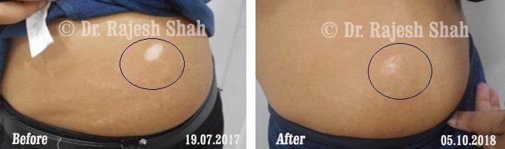 Vitiligo Before and After Case Photo