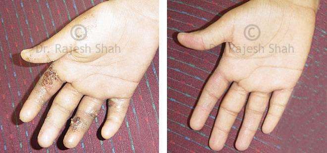 Eczema Before and After Case Photo