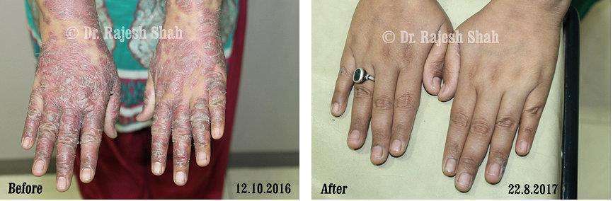 Psoriasis Before and After Case Photo