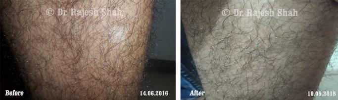 Vitiligo Before and After Case Photo