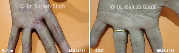 Psoriasis Before and After Case Photo