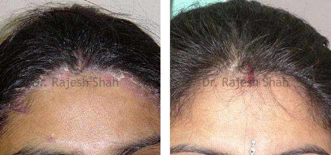 Psoriasis Before and After Case Photo