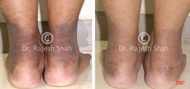 Psoriasis Before and After Case Photo