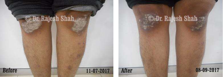 Psoriasis Before and After Case Photo