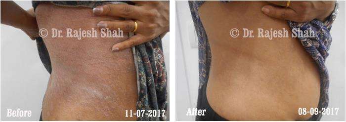 Psoriasis Before and After Case Photo