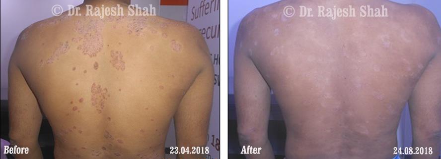 Psoriasis Before and After Case Photo