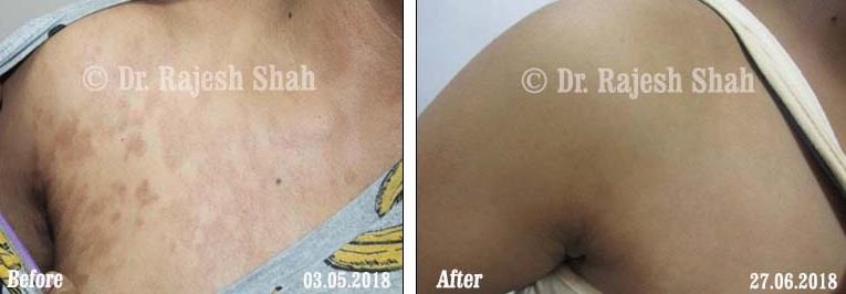 Pityriasis Rosea Before and After Case Photo