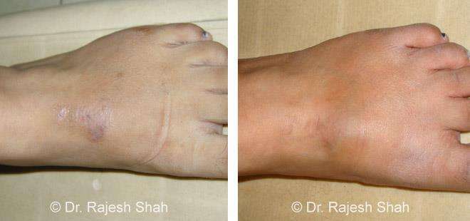 Eczema Before and After Case Photo