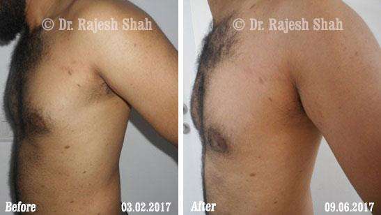 Lichen Planus Before and After Case Photo