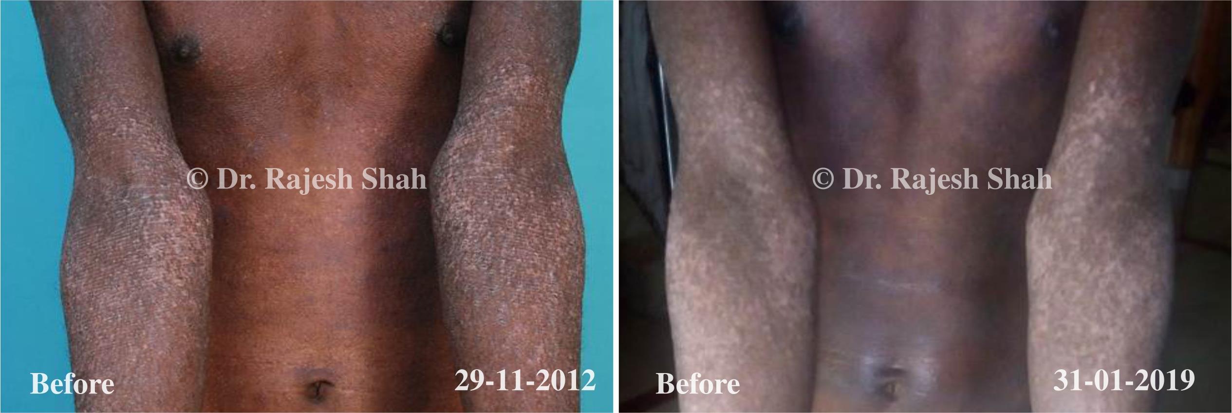 Eczema Before and After Case Photo