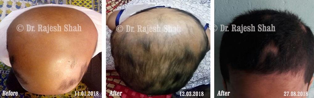 Alopecia Areata Before and After Case Photo