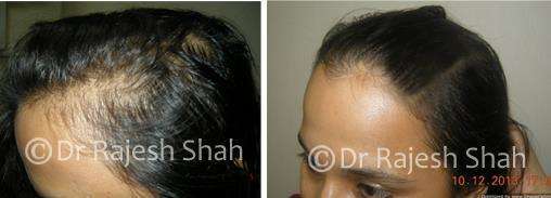 Alopecia Areata Before and After Case Photo