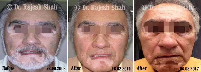 Vitiligo Before and After Case Photo