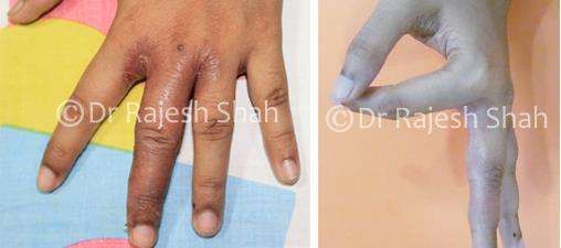 Eczema Before and After Case Photo