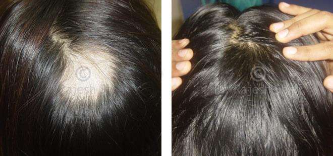 Alopecia Areata Before and After Case Photo
