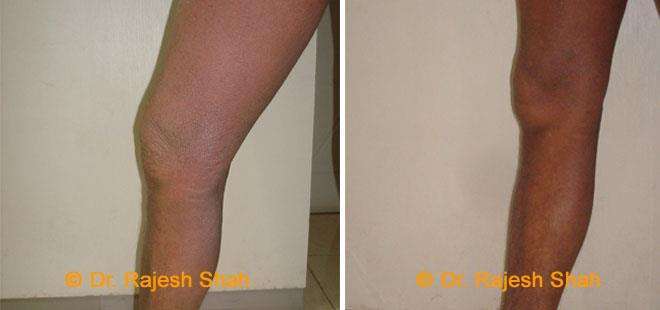 Eczema Before and After Case Photo