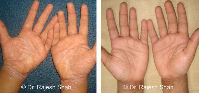 Psoriasis Before and After Case Photo