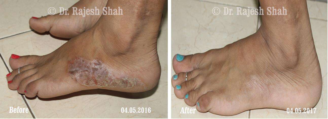 Psoriasis Before and After Case Photo