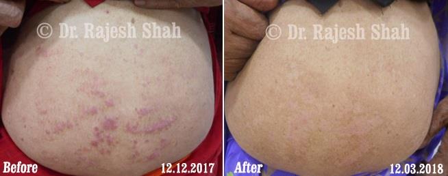 Psoriasis Before and After Case Photo