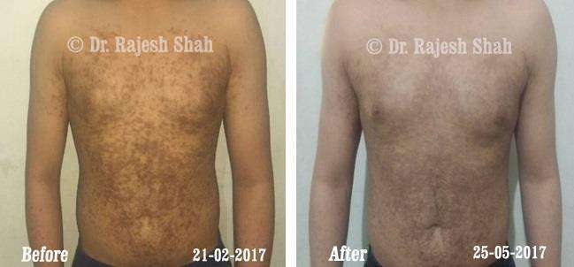 Lichen Planus Before and After Case Photo