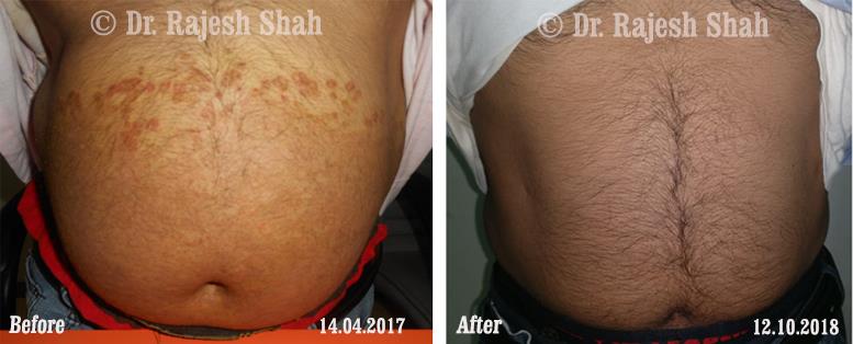 Psoriasis Before and After Case Photo